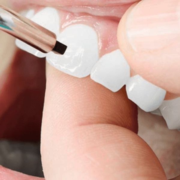 Composite Dental Bonding in Antalya, Turkey