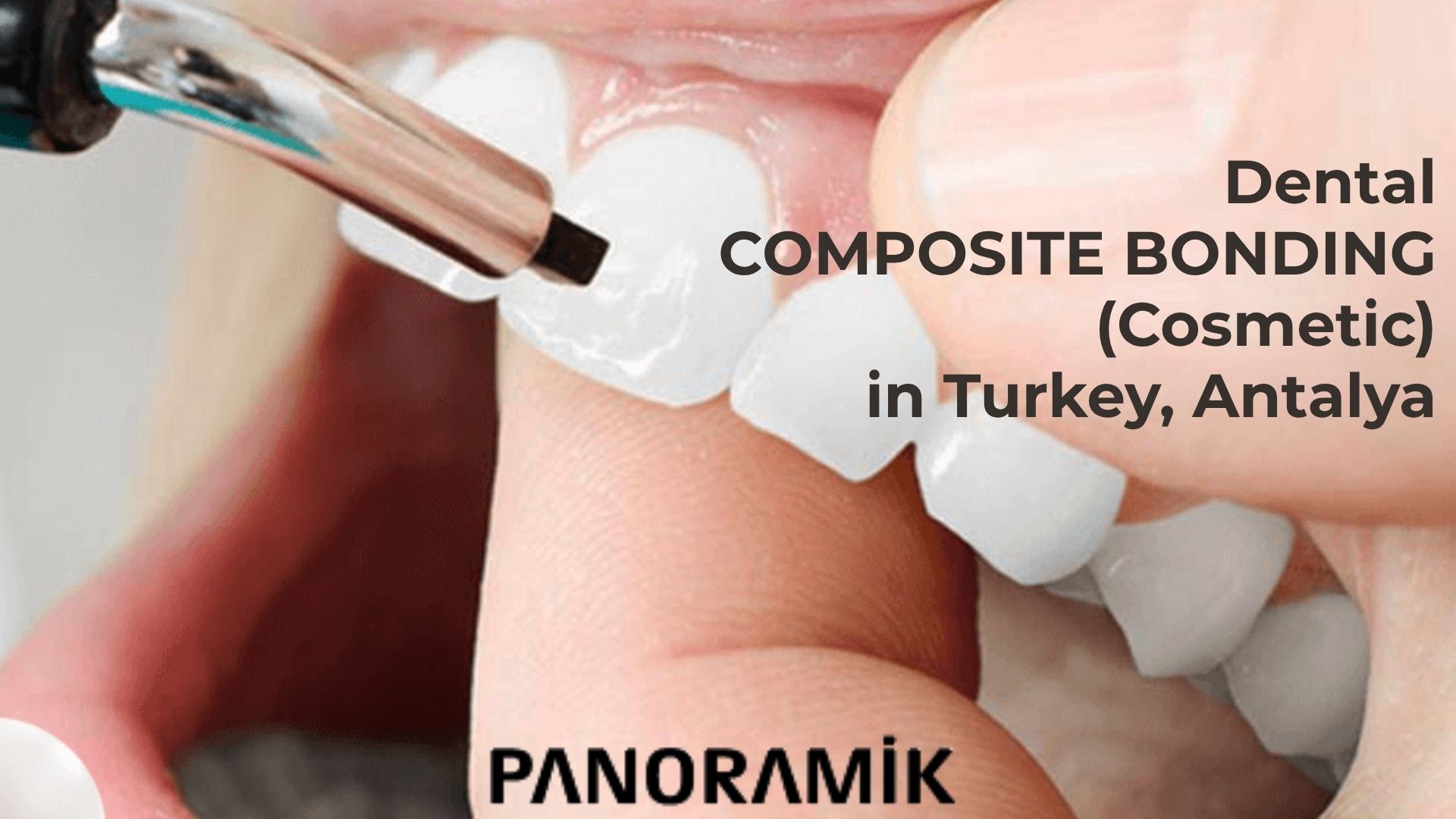 Cosmetic Teeth Bonding in Turkey, Antalya