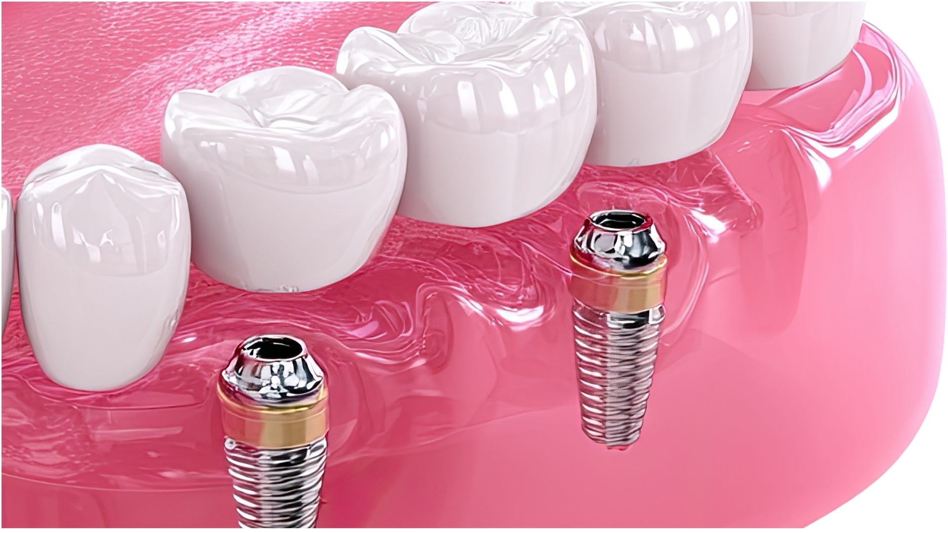 What is an implant-supported bridge? 