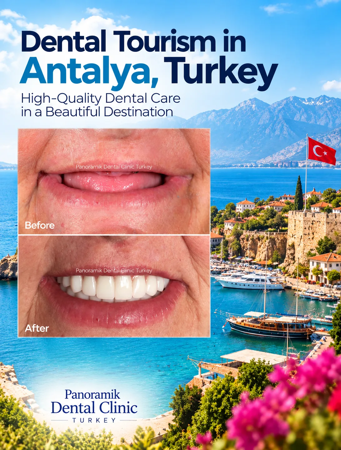 Dental tourism in Antalya day-by-day guide