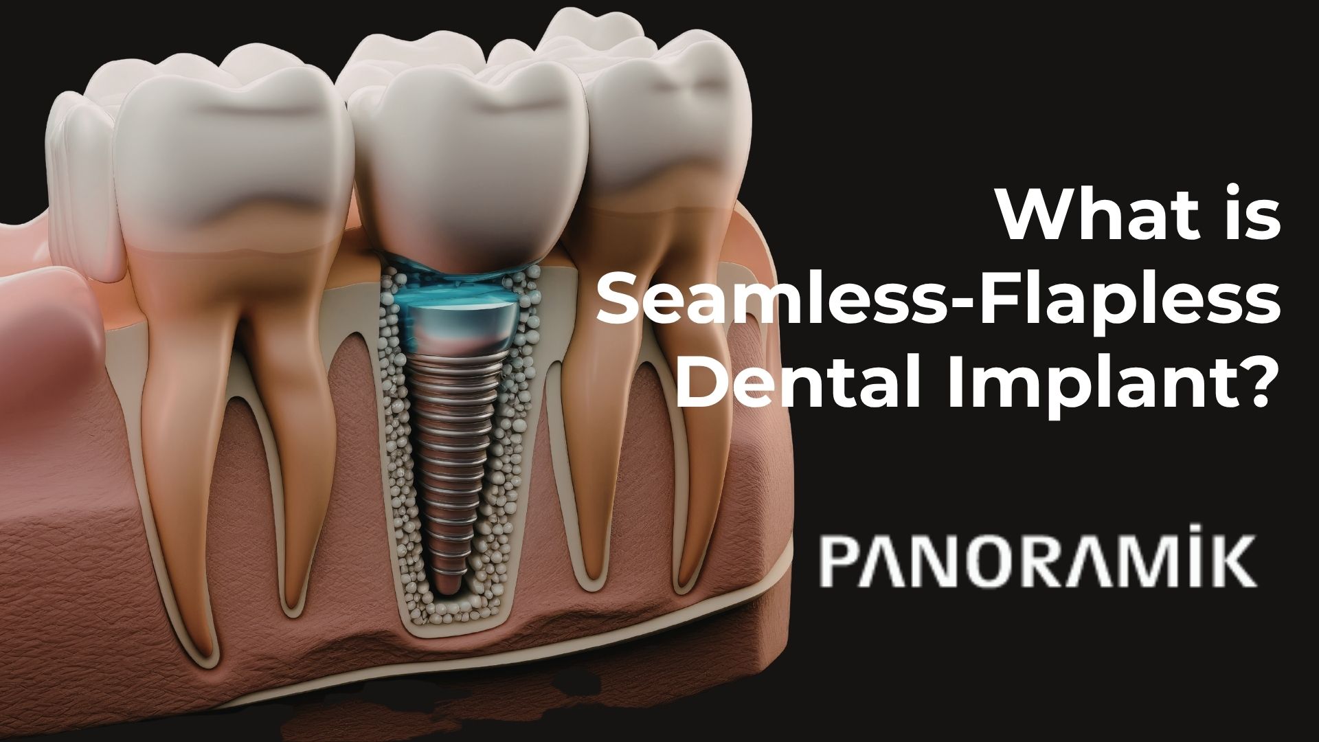What is seamless-flapless dental implant in Turkey, Antalya?