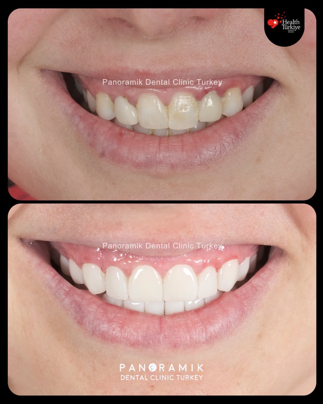 Smile design before and after at Panoramik Dental Clinic Antalya, Turkey