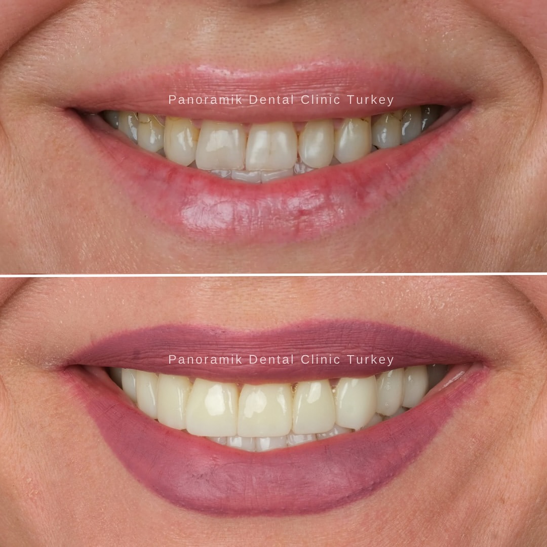 Natural-looking shade and shape: before and after at Panoramik Dental Clinic Antalya