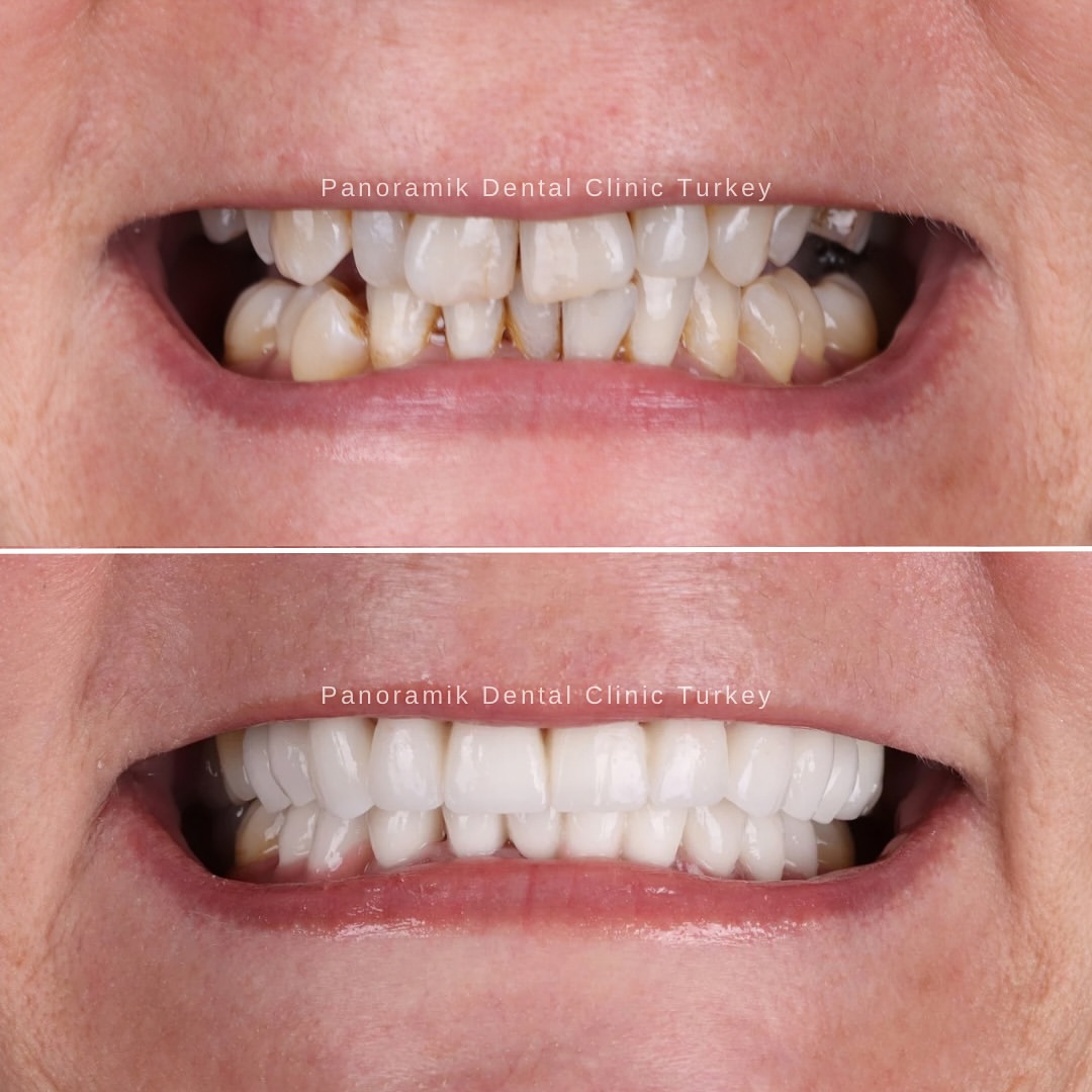 Before and after full smile restoration at Panoramik Dental Clinic Antalya
