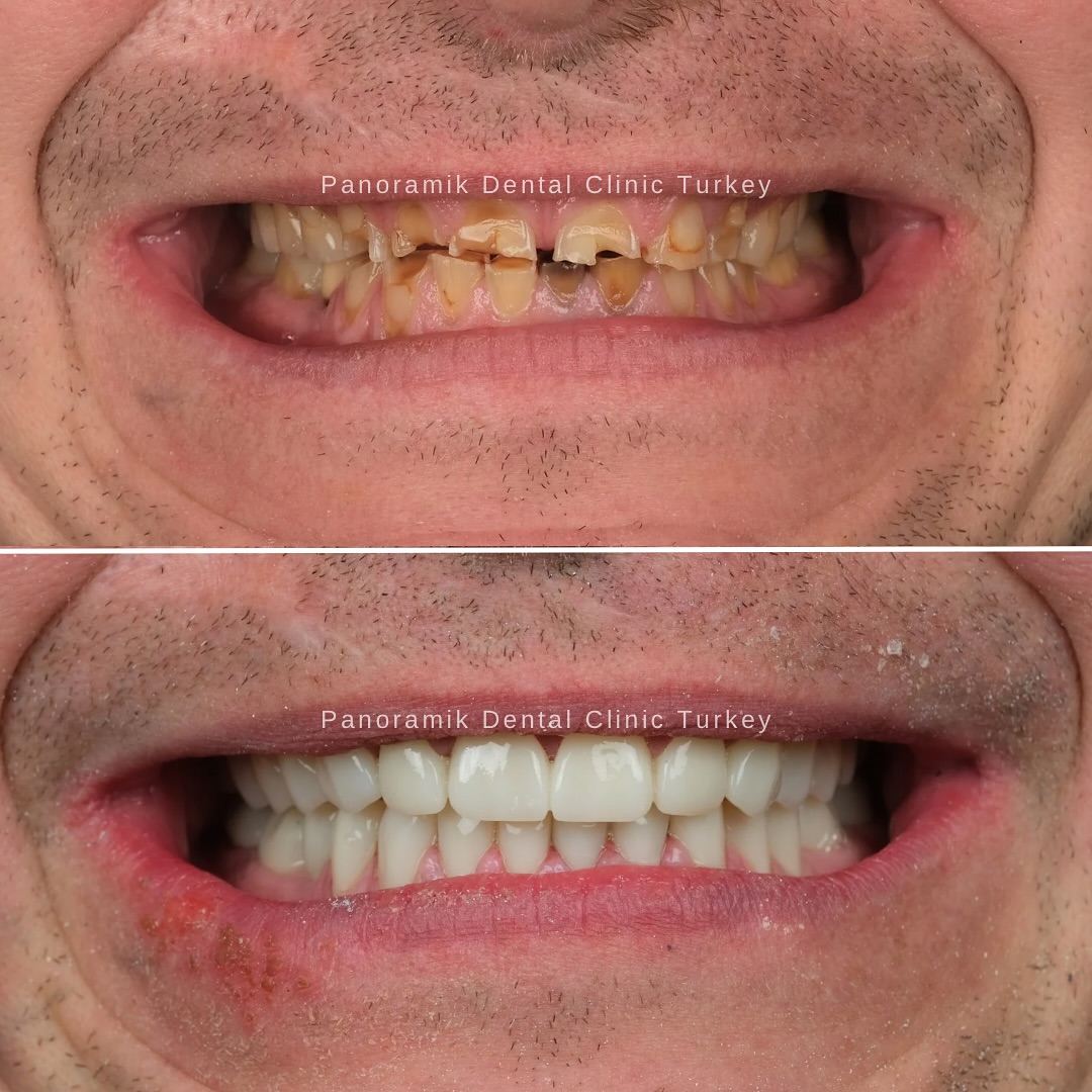 Badly worn and broken teeth restored: before and after at Panoramik Dental Clinic Antalya