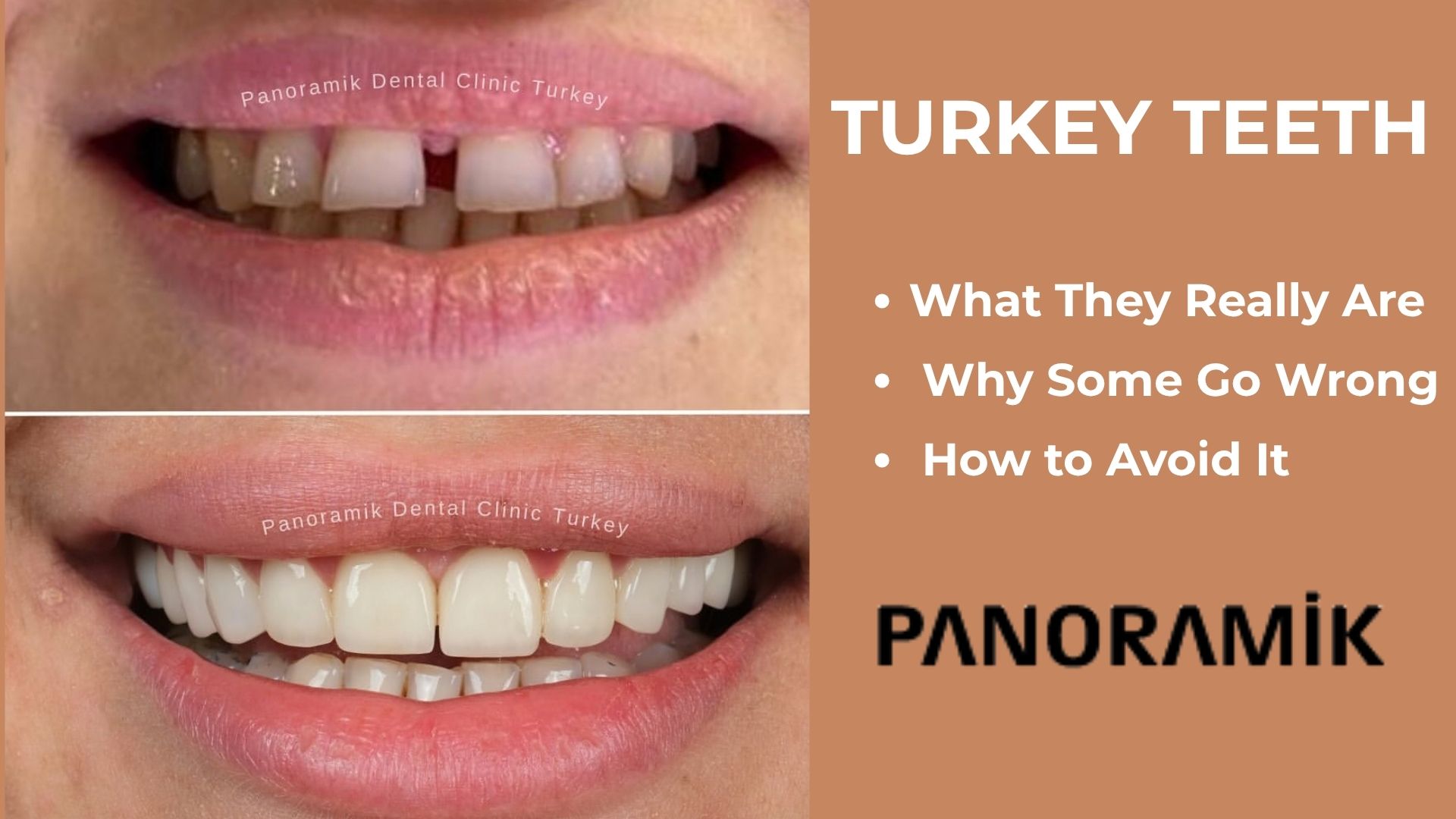 Turkey teeth in Antalya: before and after smile