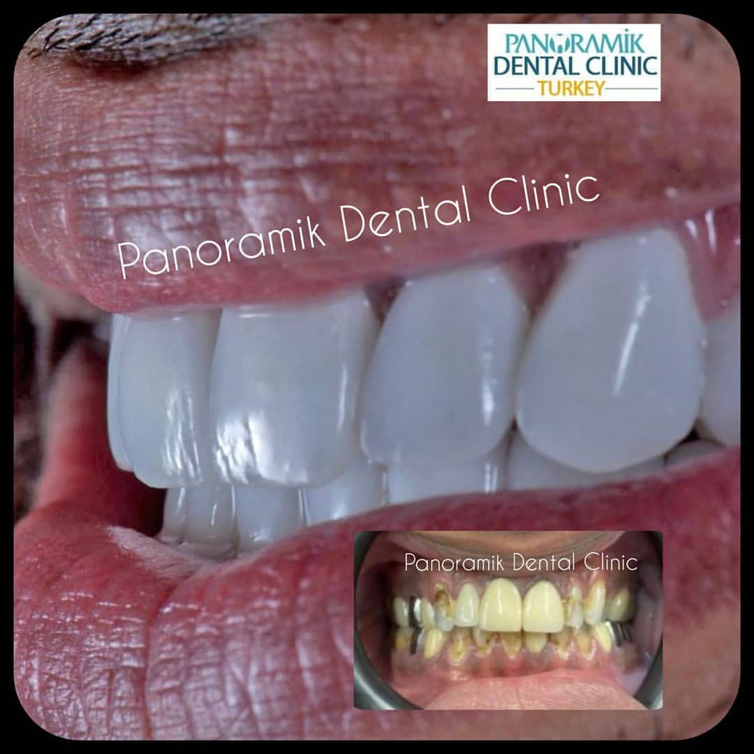 Dental crowns in Antalya Turkey 6