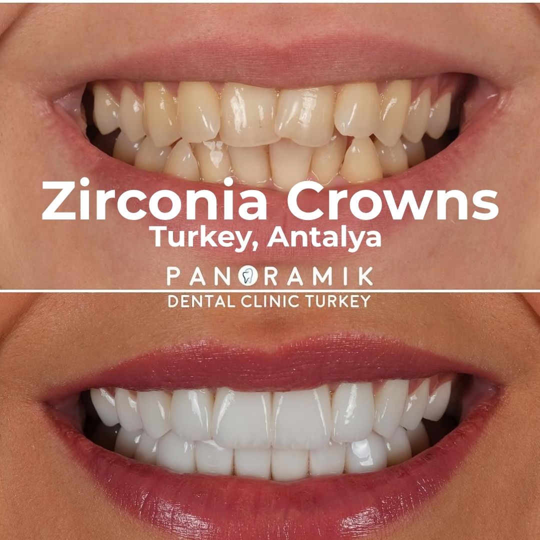 Zirconia Crown: Advantages and Disadvantages in Turkey, Antalya